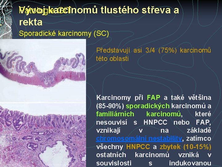 Patologie GIT Vývoj karcinomů tlustého střeva a rekta Sporadické karcinomy (SC) Představují asi 3/4 Patologie GIT Vývoj karcinomů tlustého střeva a rekta Sporadické karcinomy (SC) Představují asi 3/4