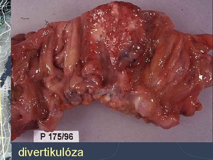 Karcinom tlustého střeva a divertikulóza Karcinom tlustého střeva a divertikulóza