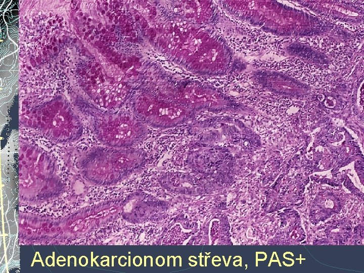 Adenokarcionom střeva, PAS+ Adenokarcionom střeva, PAS+