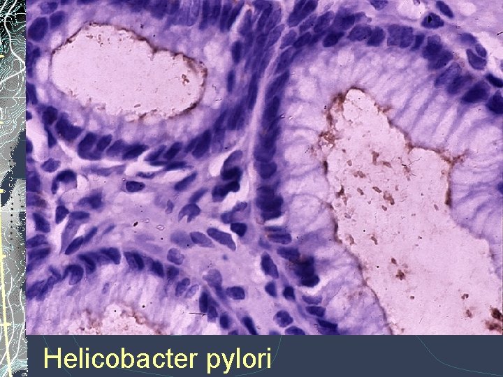 Helicobacter pylori Helicobacter pylori