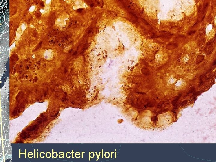 Helicobacter pylori Helicobacter pylori