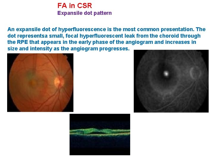 FA in CSR Expansile dot pattern An expansile dot of hyperfluorescence is the most FA in CSR Expansile dot pattern An expansile dot of hyperfluorescence is the most