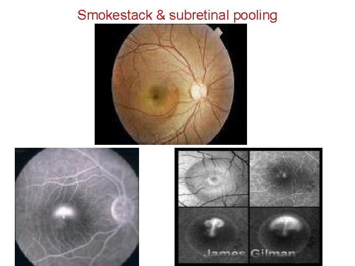 Smokestack & subretinal pooling Smokestack & subretinal pooling