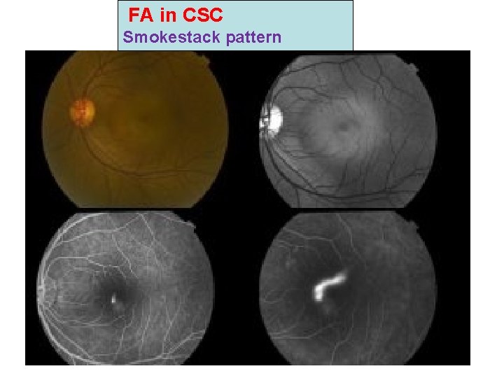 FA in CSC Smokestack pattern FA in CSC Smokestack pattern