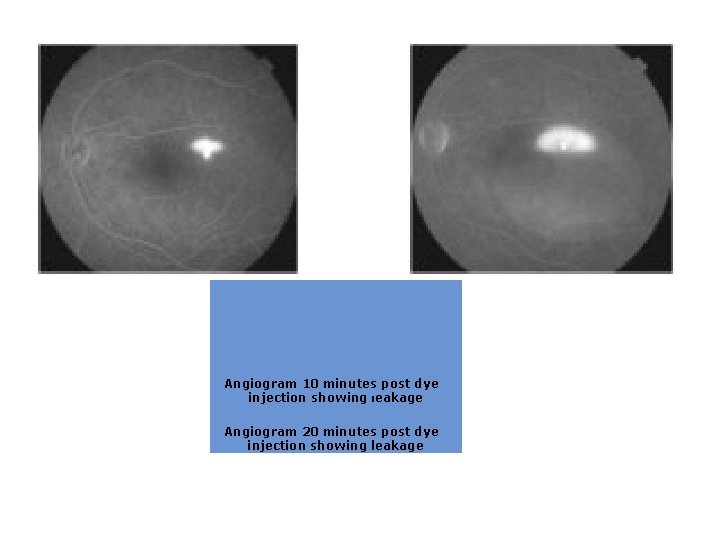 Angiogram 10 minutes post dye injection showing leakage Angiogram 20 minutes post dye Angiogram 10 minutes post dye injection showing leakage Angiogram 20 minutes post dye