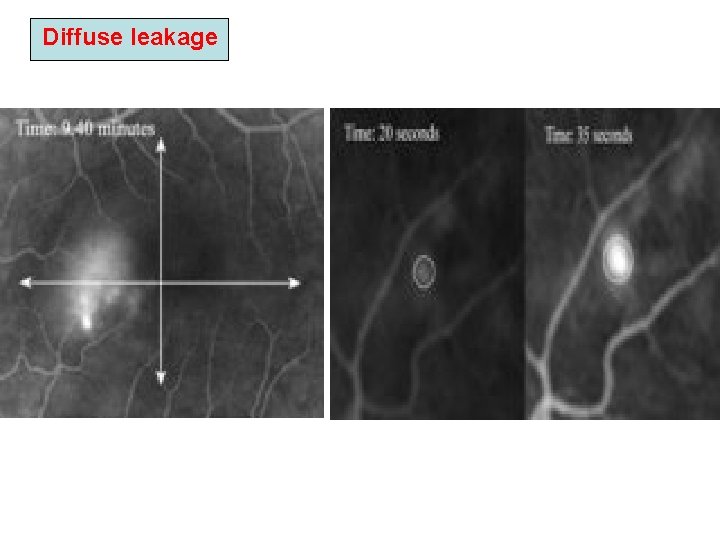Diffuse leakage Diffuse leakage