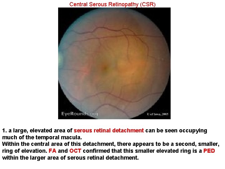Central Serous Retinopathy (CSR) 1. a large, elevated area of serous retinal detachment can Central Serous Retinopathy (CSR) 1. a large, elevated area of serous retinal detachment can
