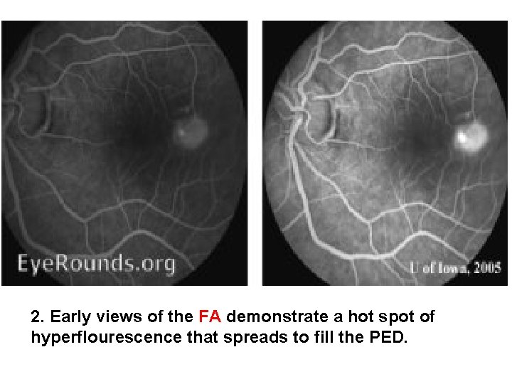 2. Early views of the FA demonstrate a hot spot of hyperflourescence that spreads 2. Early views of the FA demonstrate a hot spot of hyperflourescence that spreads