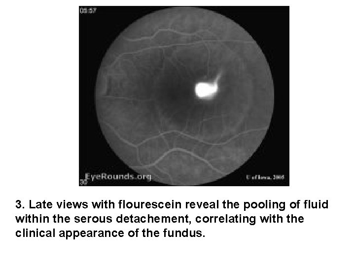 3. Late views with flourescein reveal the pooling of fluid within the serous detachement, 3. Late views with flourescein reveal the pooling of fluid within the serous detachement,