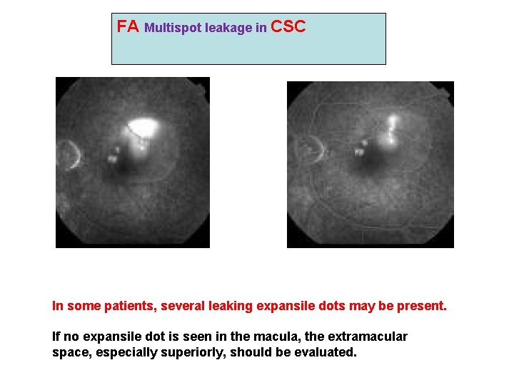FA Multispot leakage in CSC In some patients, several leaking expansile dots may be FA Multispot leakage in CSC In some patients, several leaking expansile dots may be