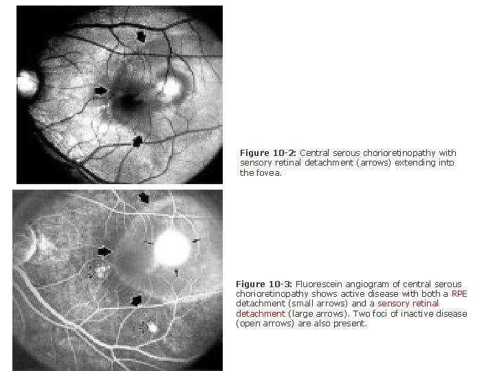 Figure 10 -2: Central serous chorioretinopathy with sensory retinal detachment (arrows) extending into Figure 10 -2: Central serous chorioretinopathy with sensory retinal detachment (arrows) extending into