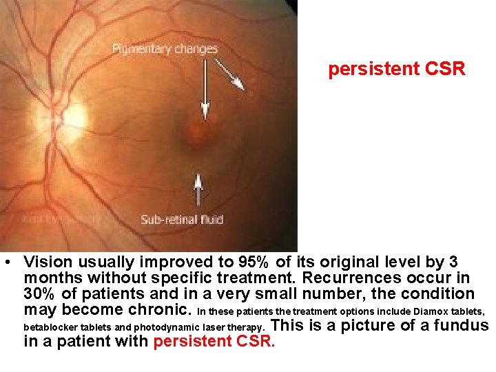 persistent CSR • Vision usually improved to 95% of its original level by 3 persistent CSR • Vision usually improved to 95% of its original level by 3