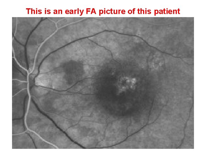 This is an early FA picture of this patient This is an early FA picture of this patient