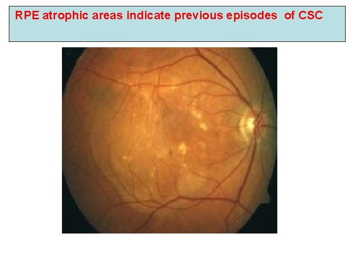 RPE atrophic areas indicate previous episodes of CSC RPE atrophic areas indicate previous episodes of CSC