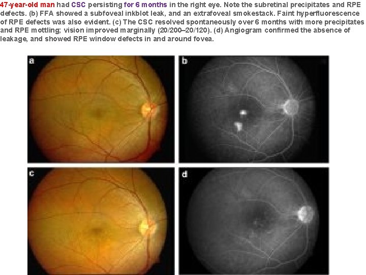 47 -year-old man had CSC persisting for 6 months in the right eye. Note 47 -year-old man had CSC persisting for 6 months in the right eye. Note