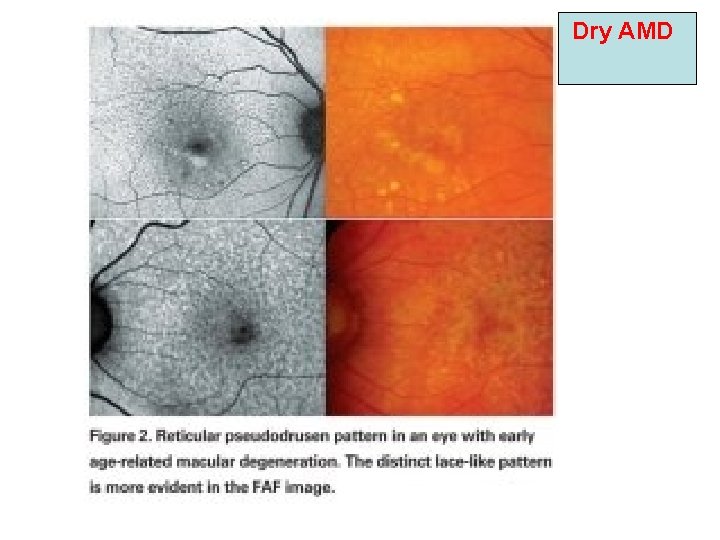 Dry AMD Dry AMD