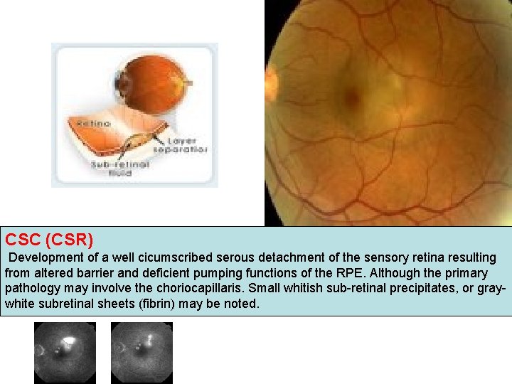 CSC (CSR) Development of a well cicumscribed serous detachment of the sensory retina resulting CSC (CSR) Development of a well cicumscribed serous detachment of the sensory retina resulting