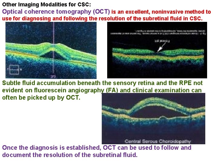 Other Imaging Modalities for CSC: Optical coherence tomography (OCT) is an excellent, noninvasive method Other Imaging Modalities for CSC: Optical coherence tomography (OCT) is an excellent, noninvasive method