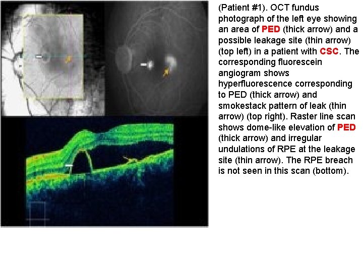 (Patient #1). OCT fundus photograph of the left eye showing an area of PED (Patient #1). OCT fundus photograph of the left eye showing an area of PED