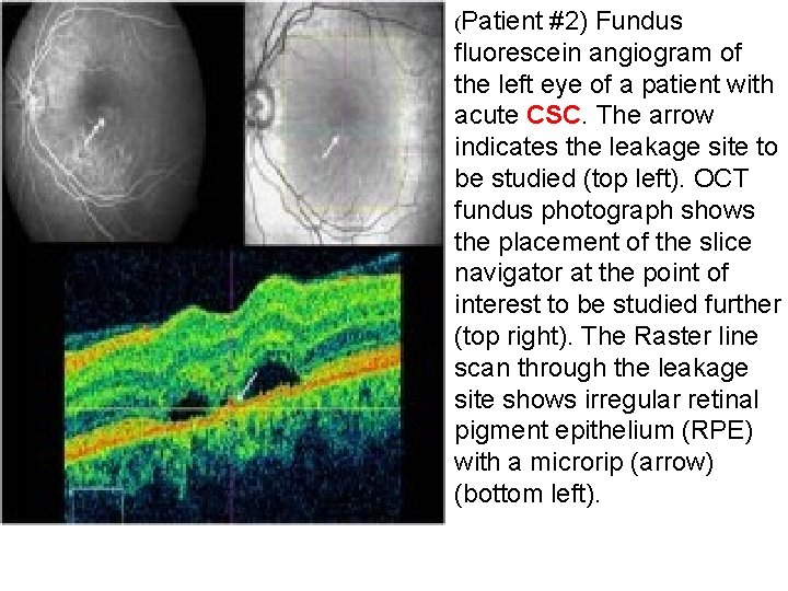 (Patient #2) Fundus fluorescein angiogram of the left eye of a patient with acute (Patient #2) Fundus fluorescein angiogram of the left eye of a patient with acute