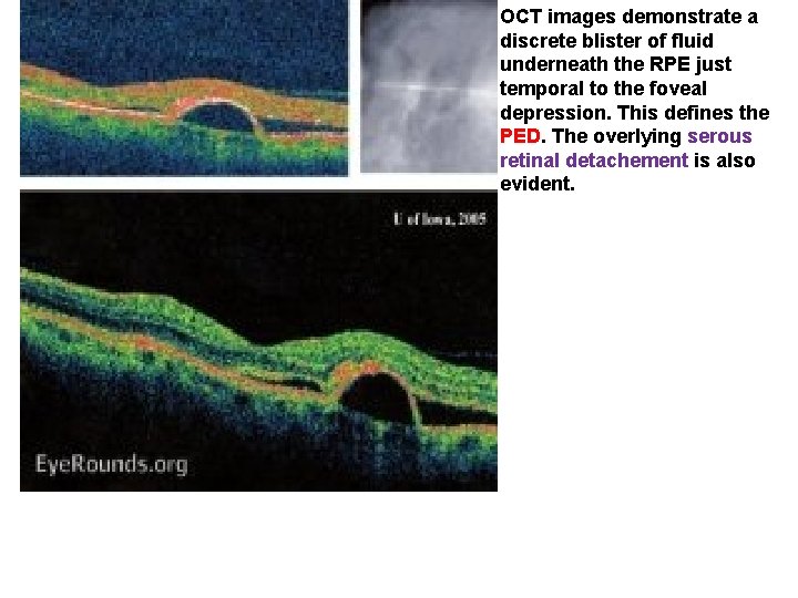 OCT images demonstrate a discrete blister of fluid underneath the RPE just temporal to OCT images demonstrate a discrete blister of fluid underneath the RPE just temporal to