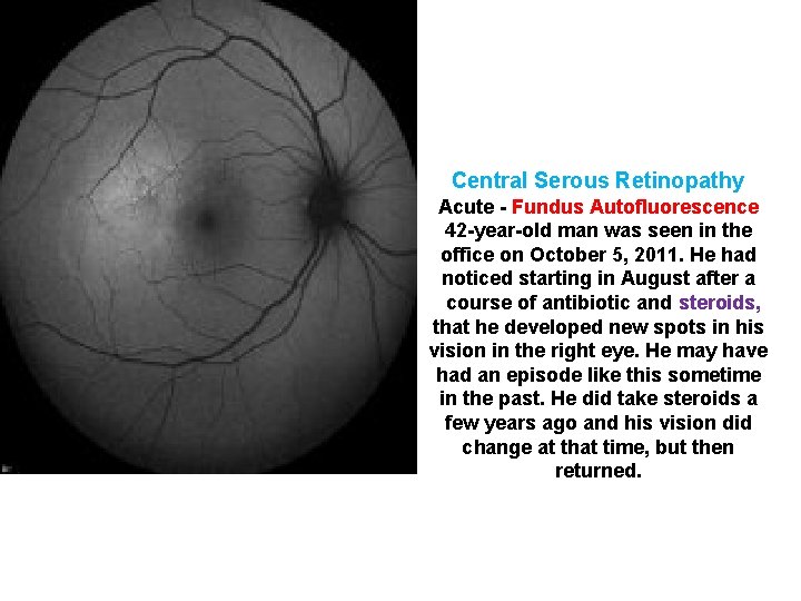Central Serous Retinopathy Acute - Fundus Autofluorescence 42 -year-old man was seen in the Central Serous Retinopathy Acute - Fundus Autofluorescence 42 -year-old man was seen in the