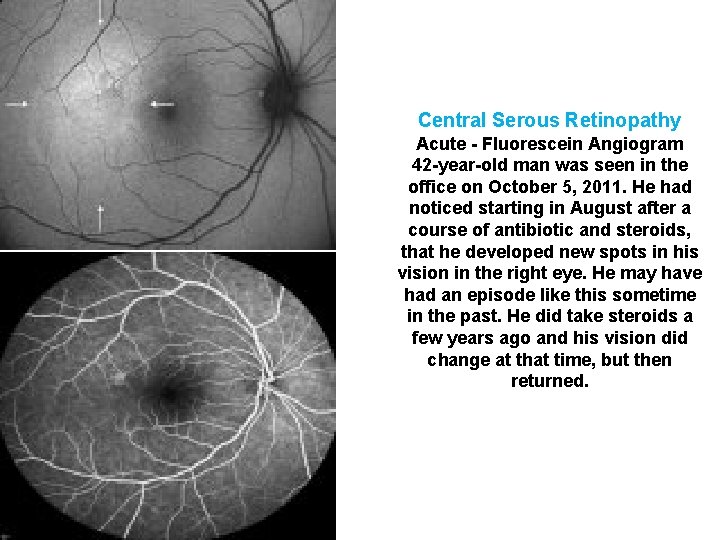 Central Serous Retinopathy Acute - Fluorescein Angiogram 42 -year-old man was seen in the Central Serous Retinopathy Acute - Fluorescein Angiogram 42 -year-old man was seen in the