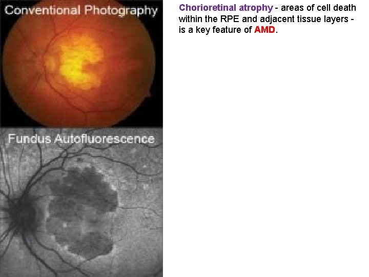 Chorioretinal atrophy - areas of cell death within the RPE and adjacent tissue layers Chorioretinal atrophy - areas of cell death within the RPE and adjacent tissue layers