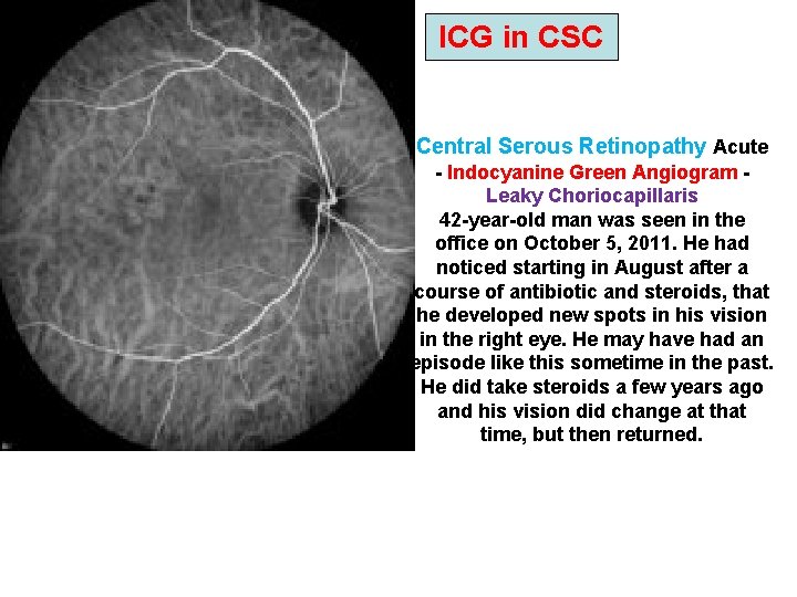 ICG in CSC Central Serous Retinopathy Acute - Indocyanine Green Angiogram - Leaky ICG in CSC Central Serous Retinopathy Acute - Indocyanine Green Angiogram - Leaky
