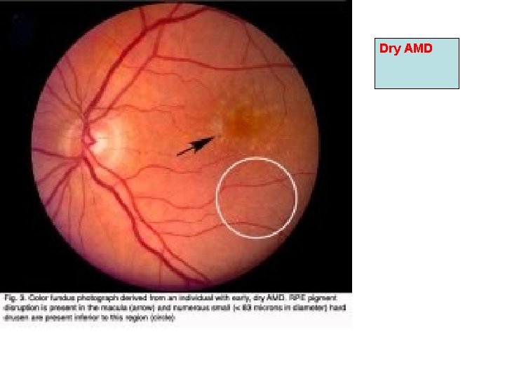 Dry AMD Dry AMD