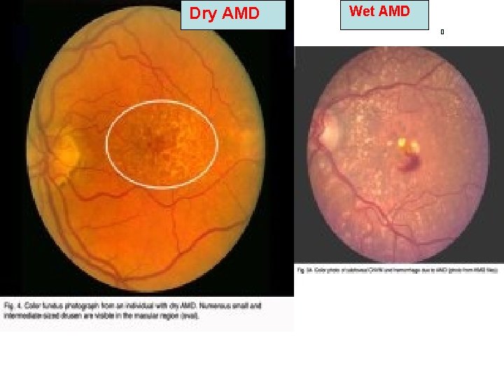 Dry AMD Wet AMD Dry AMD Wet AMD
