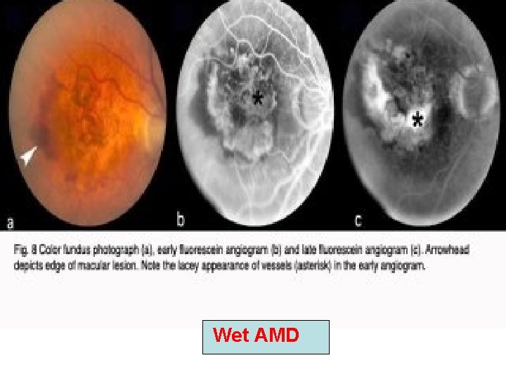Wet AMD Wet AMD