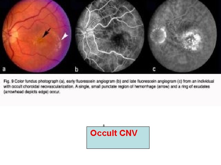 Occult CNV Occult CNV