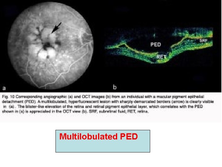 Multilobulated PED Multilobulated PED
