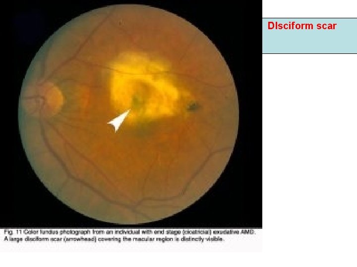 Dlsciform scar Dlsciform scar