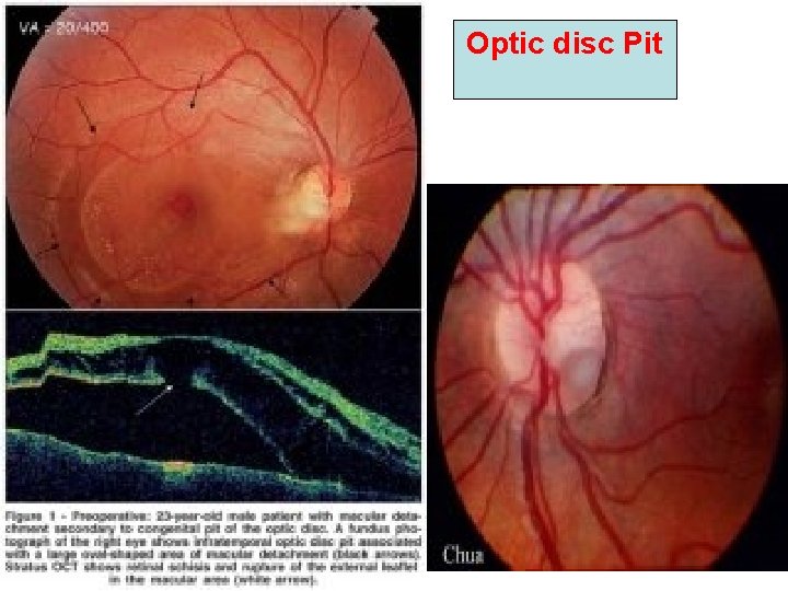 Optic disc Pit Optic disc Pit