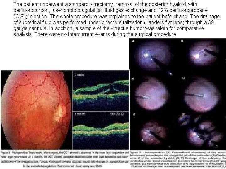 The patient underwent a standard vitrectomy, removal of the posterior hyaloid, with perfluorocarbon, laser The patient underwent a standard vitrectomy, removal of the posterior hyaloid, with perfluorocarbon, laser