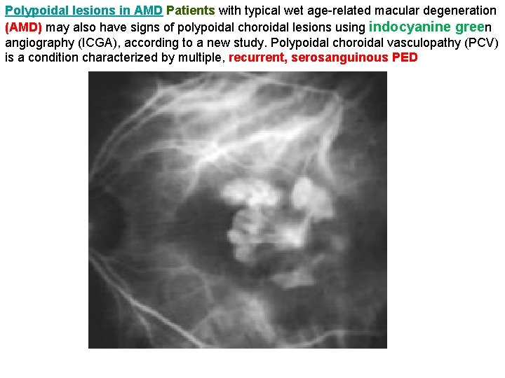 Polypoidal lesions in AMD Patients with typical wet age-related macular degeneration (AMD) may also Polypoidal lesions in AMD Patients with typical wet age-related macular degeneration (AMD) may also