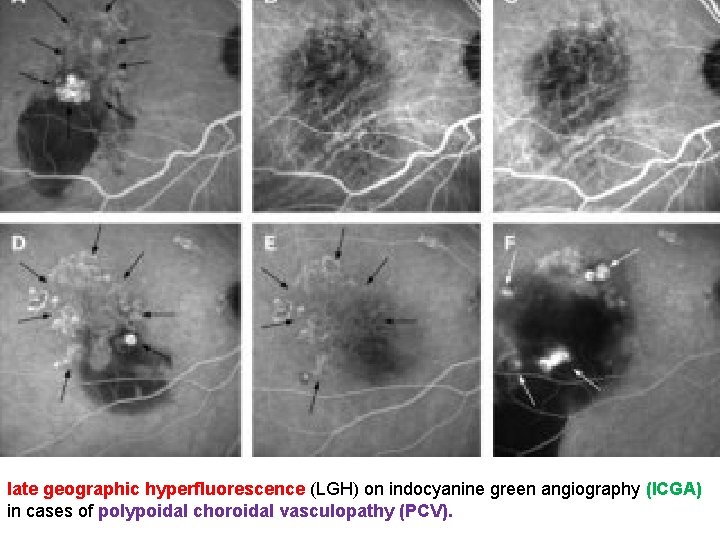 late geographic hyperfluorescence (LGH) on indocyanine green angiography (ICGA) in cases of polypoidal choroidal late geographic hyperfluorescence (LGH) on indocyanine green angiography (ICGA) in cases of polypoidal choroidal