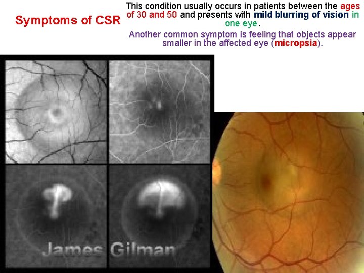 Symptoms of CSR This condition usually occurs in patients between the ages of 30 Symptoms of CSR This condition usually occurs in patients between the ages of 30