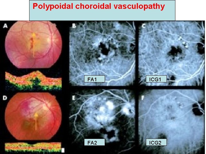 Polypoidal choroidal vasculopathy FA 1 ICG 1 FA 2 ICG 2 Polypoidal choroidal vasculopathy FA 1 ICG 1 FA 2 ICG 2