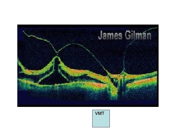 VMT VMT