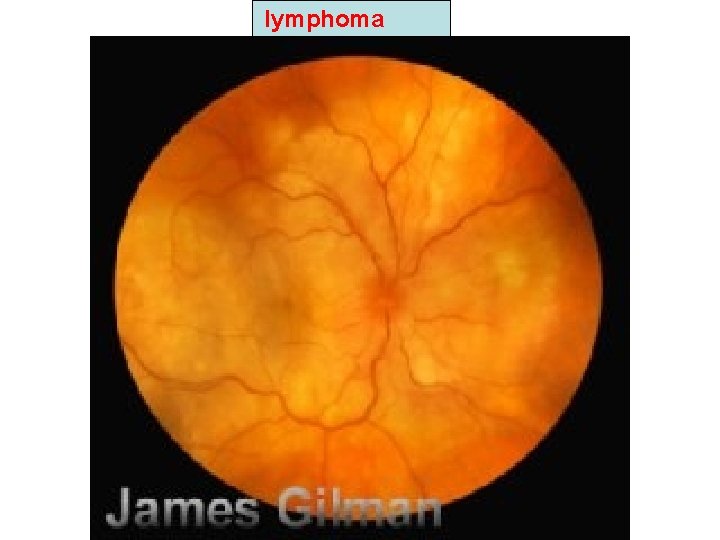 lymphoma lymphoma