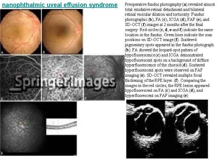 nanophthalmic uveal effusion syndrome Preoperative fundus photography (a) revealed almost total exudative retinal detachment nanophthalmic uveal effusion syndrome Preoperative fundus photography (a) revealed almost total exudative retinal detachment