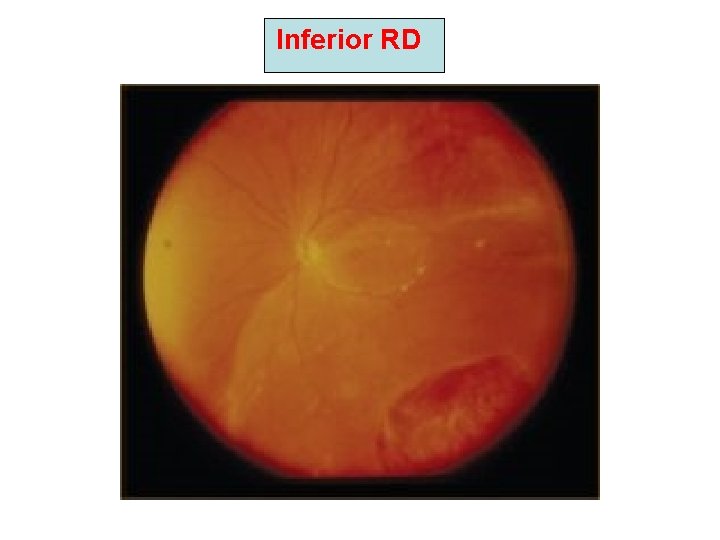 Inferior RD Inferior RD