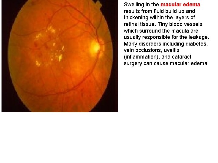 Swelling in the macular edema results from fluid build up and thickening within the Swelling in the macular edema results from fluid build up and thickening within the