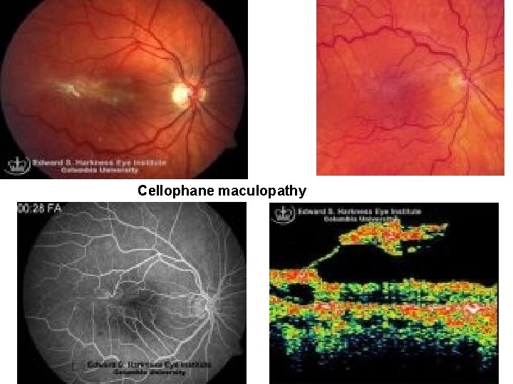 Cellophane maculopathy Cellophane maculopathy