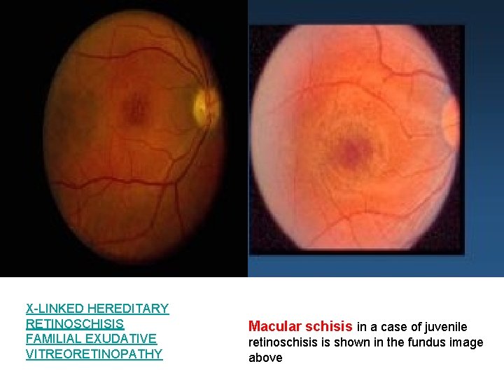 X-LINKED HEREDITARY RETINOSCHISIS FAMILIAL EXUDATIVE VITREORETINOPATHY Macular schisis in a case of juvenile retinoschisis X-LINKED HEREDITARY RETINOSCHISIS FAMILIAL EXUDATIVE VITREORETINOPATHY Macular schisis in a case of juvenile retinoschisis