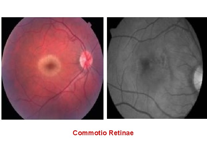 Commotio Retinae Commotio Retinae