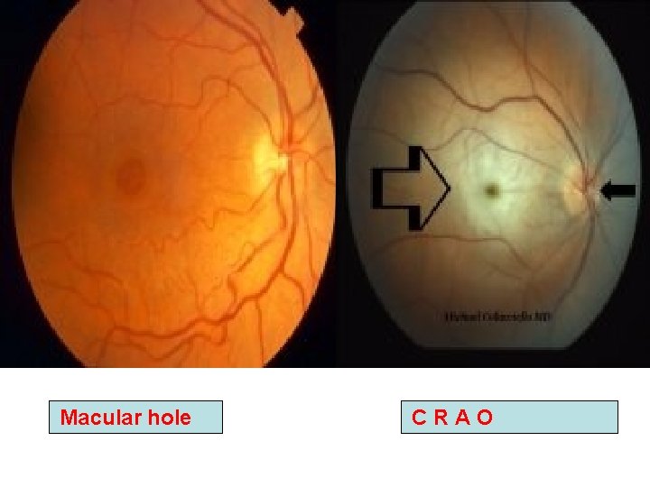 Macular hole C R A O Macular hole C R A O